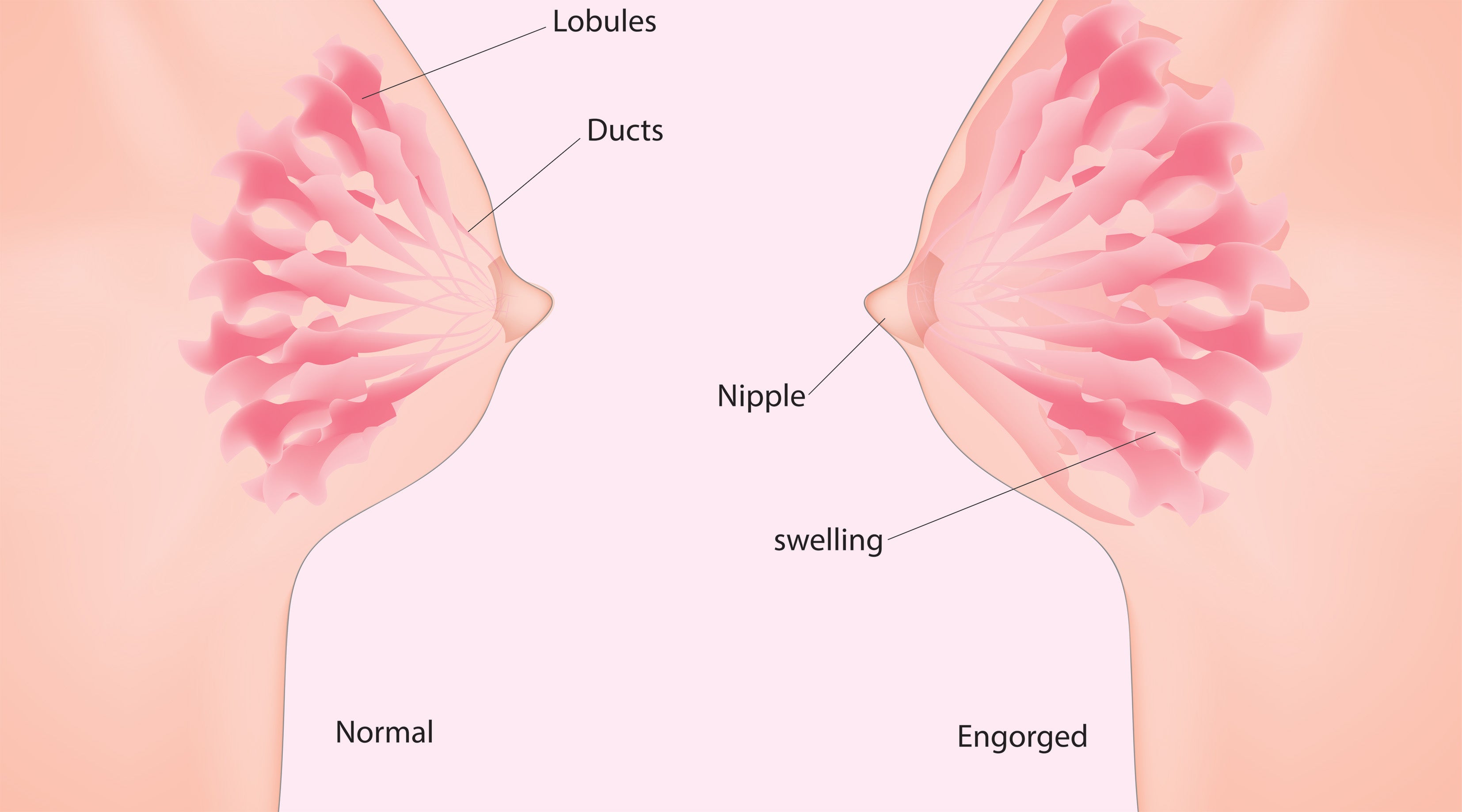 How to Make a Warm Compress for Breast Engorgement or Pain