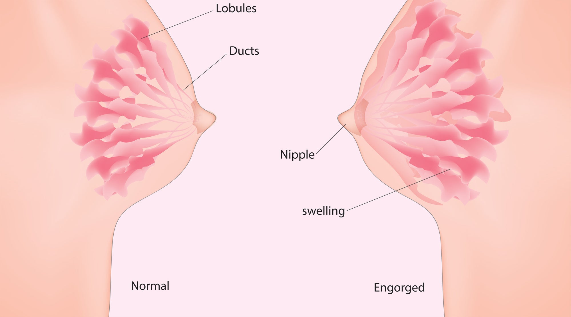 What is the Difference Between a Clogged Duct and Engorgement?
