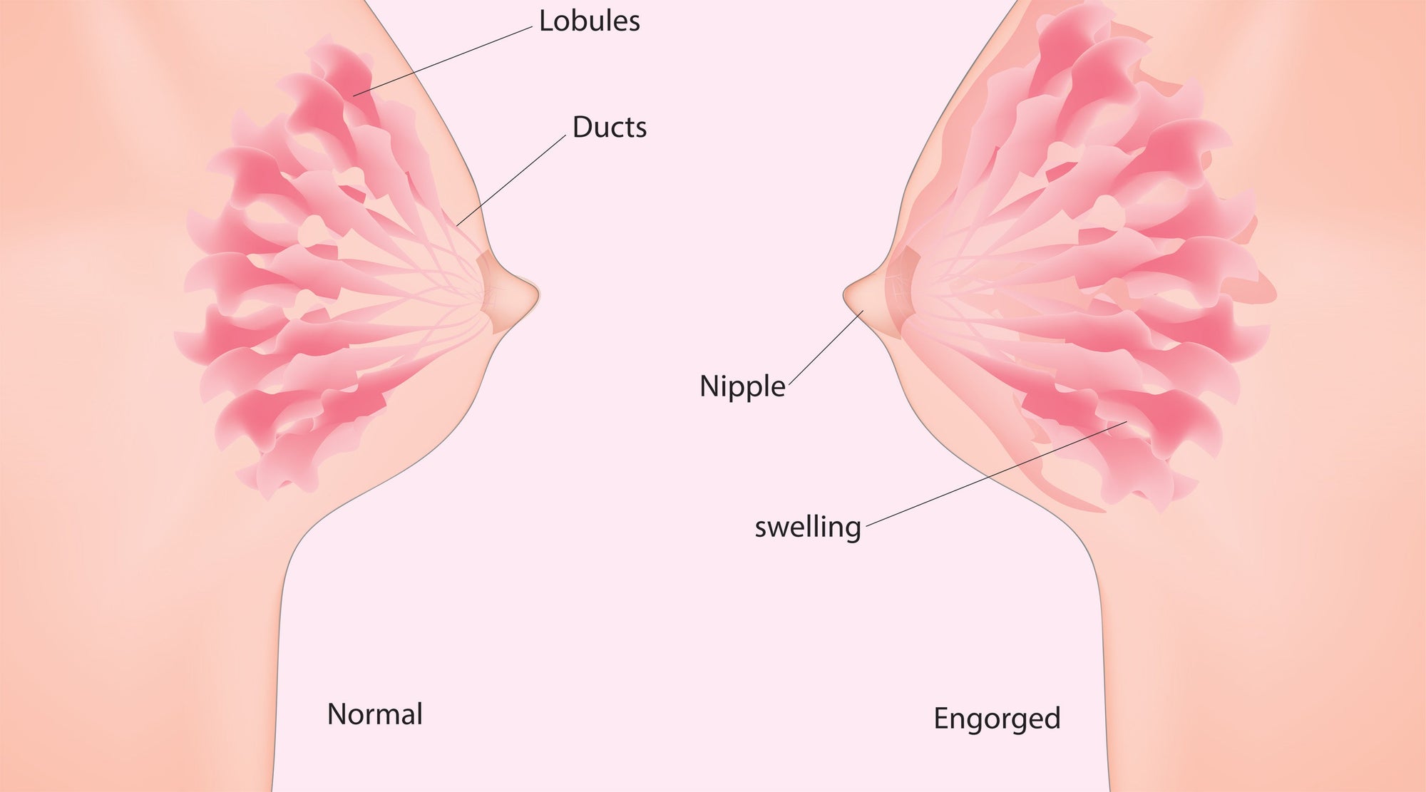 Medical illustration comparing a normal breast and an engorged breast, showing lobules, milk ducts, nipple, and swelling.