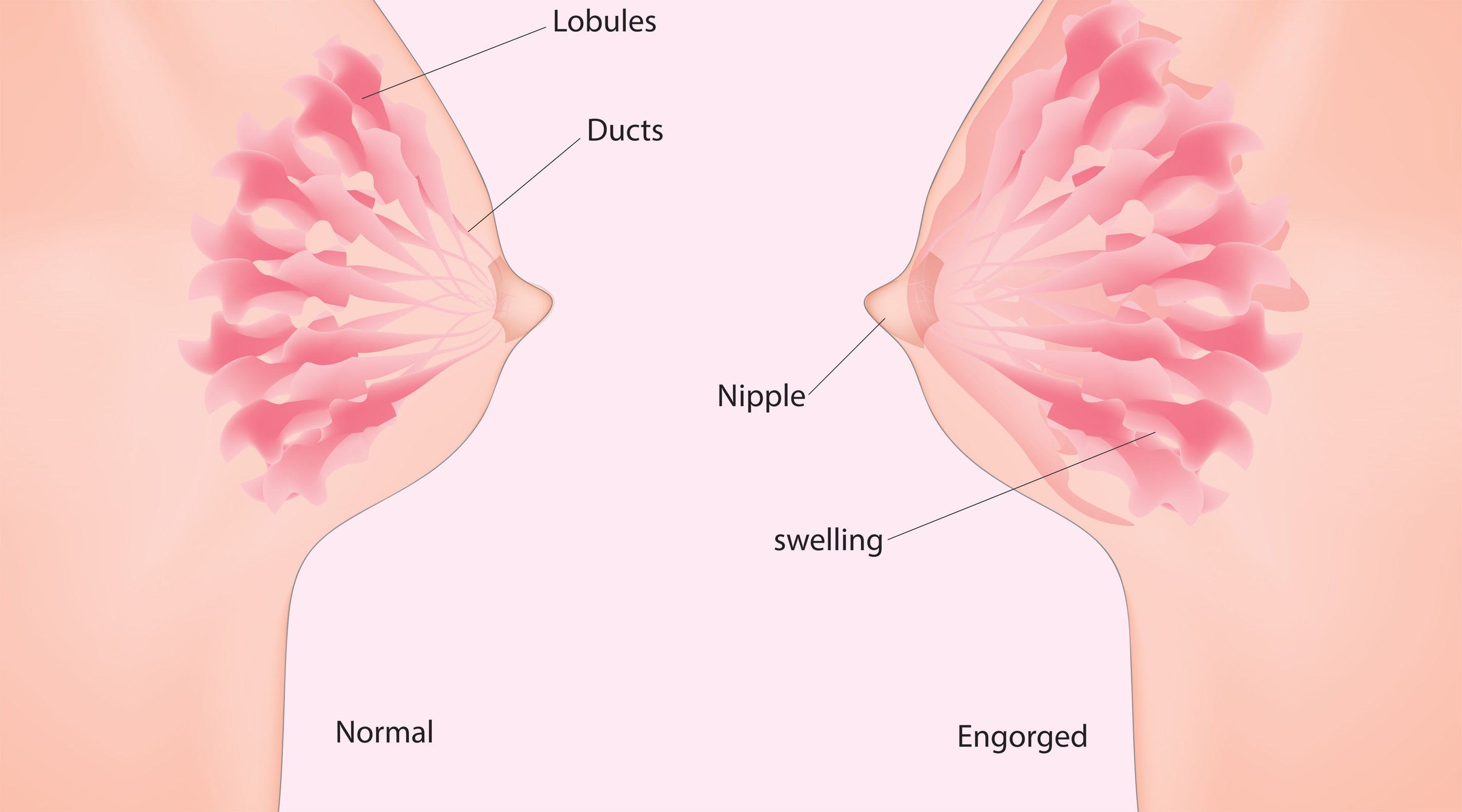 Medical illustration comparing a normal breast and an engorged breast, showing lobules, milk ducts, nipple, and swelling.
